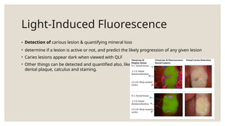 Light-Induced Fluorescence
• Detection of carious lesion & quantifying mineral loss
• determine if a lesion is active or not, and predict the likely progression of any given lesion
• Caries lesions appear dark when viewed with QLF
• Other things can be detected and quantified also, like
dental plaque, calculus and staining.
 