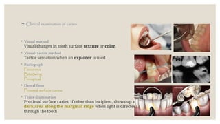  Clinical examination of caries
◦ Visual method
Visual changes in tooth surface texture or color.
◦ Visual- tactile method
Tactile sensation when an explorer is used
◦ Radiograph
Panorama
Bite0wing
Periapical
◦ Dental floss
Proximal surface caries
◦ Trans-illumination
Proximal surface caries, if other than incipient, shows up as a
dark area along the marginal ridge when light is directed
through the tooth
 