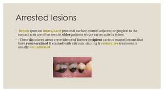 Arrested lesions
◦ Brown spots on intact, hard proximal surface enamel adjacent or gingival to the
contact area are often seen in older patients whose caries activity is low.
◦ - These discolored areas are evidence of former incipient carious enamel lesions that
have remineralized & stained with extrinsic staining & restorative treatment is
usually not indicated
 