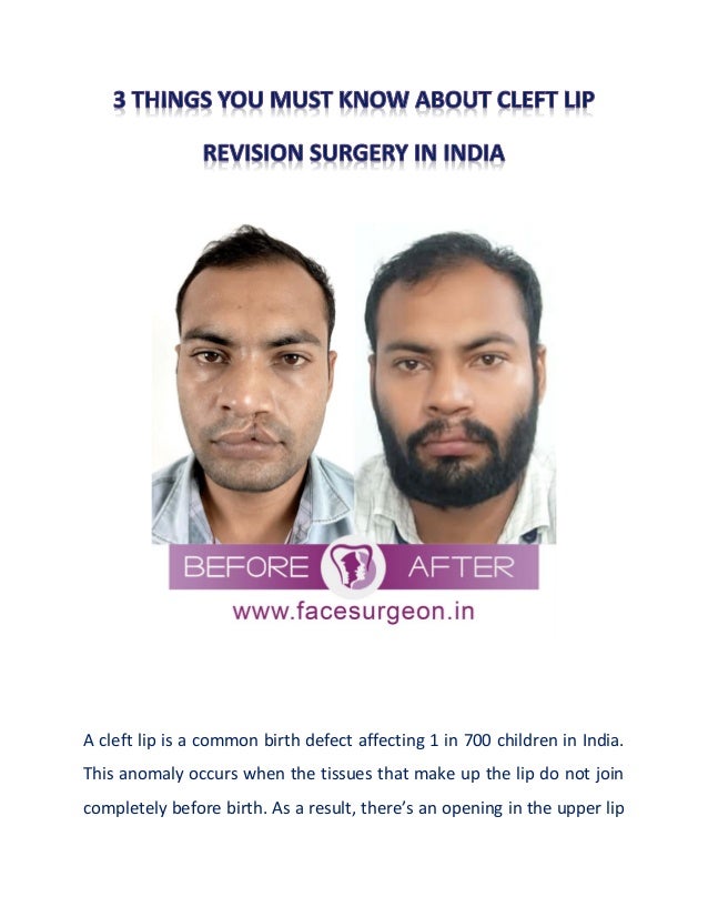 A cleft lip is a common birth defect affecting 1 in 700 children in India.
This anomaly occurs when the tissues that make up the lip do not join
completely before birth. As a result, there’s an opening in the upper lip
 