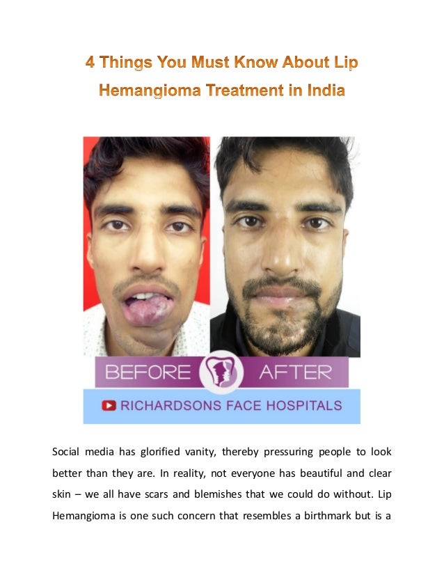 Social media has glorified vanity, thereby pressuring people to look
better than they are. In reality, not everyone has beautiful and clear
skin – we all have scars and blemishes that we could do without. Lip
Hemangioma is one such concern that resembles a birthmark but is a
 