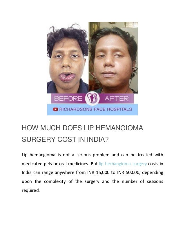 HOW MUCH DOES LIP HEMANGIOMA
SURGERY COST IN INDIA?
Lip hemangioma is not a serious problem and can be treated with
medicated gels or oral medicines. But lip hemangioma surgery costs in
India can range anywhere from INR 15,000 to INR 50,000, depending
upon the complexity of the surgery and the number of sessions
required.
 