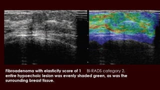 All thing breast ultrasound breast mammography part 1