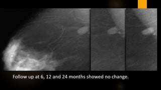 All thing breast ultrasound breast mammography part 2