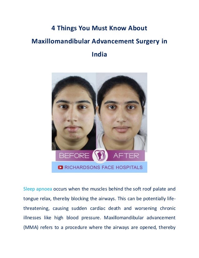 4 Things You Must Know About
Maxillomandibular Advancement Surgery in
India
Sleep apnoea occurs when the muscles behind the soft roof palate and
tongue relax, thereby blocking the airways. This can be potentially life-
threatening, causing sudden cardiac death and worsening chronic
illnesses like high blood pressure. Maxillomandibular advancement
(MMA) refers to a procedure where the airways are opened, thereby
 