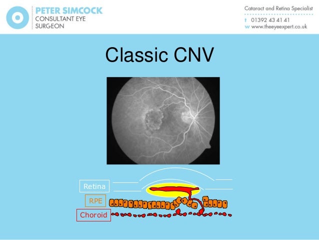 Natural Treatment For Wet Amd Natural Treatment For Wet Amd