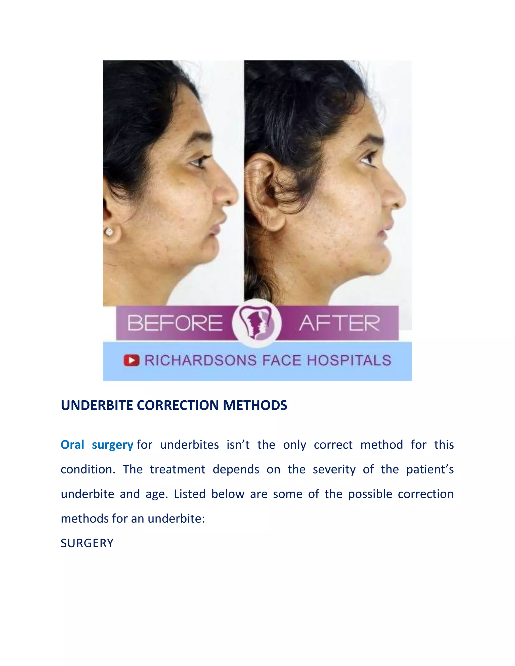 UNDERBITE CORRECTION METHODS
Oral surgery for underbites isn’t the only correct method for this
condition. The treatment depends on the severity of the patient’s
underbite and age. Listed below are some of the possible correction
methods for an underbite:
SURGERY
 