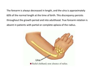 All you want to know about radial dysplasia | PPTX