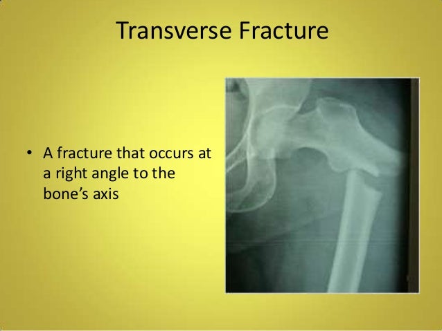 nondisplaced transverse fracture