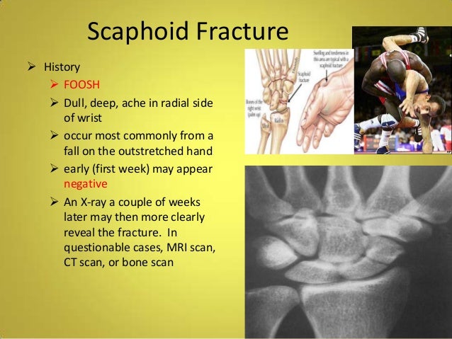 colles fracture smith fracture colles fracture smith fracture