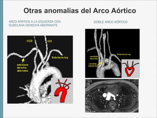Otras anomalías del Arco Aórtico 
ARCO AÓRTICO A LA IZQUIERDA CON 
SUBCLAVIA DERECHA ABERRANTE 
DOBLE ARCO AÓRTICO 
 