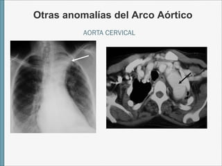 Otras anomalías del Arco Aórtico 
AORTA CERVICAL 
 