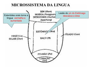 Lesão do yin do Estômago
descasca a áreaEsteróides orais torna a
língua vermelha e
aumentada
 