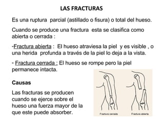 Es una ruptura  parcial (astillado o fisura) o total del hueso. Cuando se produce una fractura  esta se clasifica como abierta o cerrada :  Fractura abierta  :  El hueso atraviesa la piel  y es visible , o una herida  profunda a través de la piel lo deja a la vista.  Fractura cerrada :  El hueso se rompe pero la piel permanece intacta. LAS FRACTURAS Causas  Las fracturas se producen cuando se ejerce sobre el hueso una fuerza mayor de la que este puede absorber. 