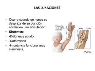 Ocurre cuando un hueso se desplaza de su posición normal en una articulación. Síntomas : -Dolor muy agudo. -Deformidad -Impotencia funcional muy manifiesta. LAS LUXACIONES 