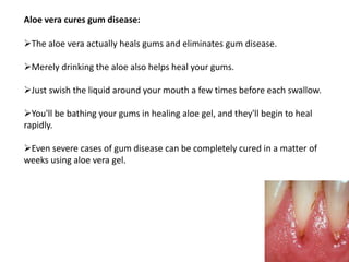Aloe vera cures gum disease:
The aloe vera actually heals gums and eliminates gum disease.
Merely drinking the aloe also helps heal your gums.
Just swish the liquid around your mouth a few times before each swallow.
You'll be bathing your gums in healing aloe gel, and they'll begin to heal
rapidly.
Even severe cases of gum disease can be completely cured in a matter of
weeks using aloe vera gel.
 