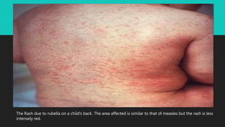 The Rash due to rubella on a child’s back. The area affected is similar to that of measles but the rash is less
intensely red.
 