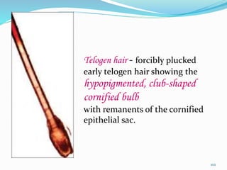 Telogen hair - forcibly plucked
early telogen hair showing the
hypopigmented, club-shaped
cornified bulb
with remanents of the cornified
epithelial sac.
102
 