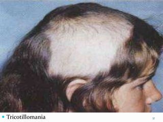  Tricotillomania 37
 