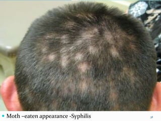  Moth –eaten appearance -Syphilis 38
 