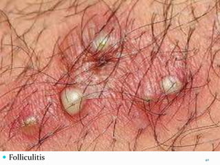  Folliculitis 40
 