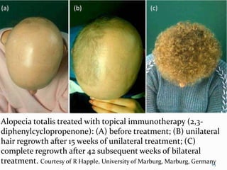 Alopecia totalis treated with topical immunotherapy (2,3-
diphenylcyclopropenone): (A) before treatment; (B) unilateral
hair regrowth after 15 weeks of unilateral treatment; (C)
complete regrowth after 42 subsequent weeks of bilateral
treatment. Courtesy of R Happle, University of Marburg, Marburg, Germany63
 