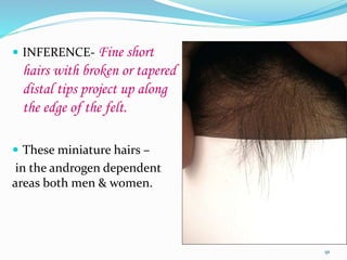  INFERENCE- Fine short
hairs with broken or tapered
distal tips project up along
the edge of the felt.
 These miniature hairs –
in the androgen dependent
areas both men & women.
91
 