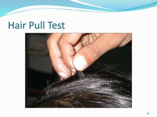 Hair Pull Test
95
 