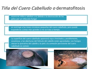 ocurre en niños y adultos y es debido a la destrucción de los
pelos por un infección fungal
se restringe a las áreas circulares pequeñas del cuero cabelludo, pero puede
expanderse a áreas más grandes si no se trata a tiempo.
La superficie del cuero cabelludo aparecerá roja e hinchada y, posiblemente,
escamosa, y las aberturas del folículo del cabello están agrandadas. Los hongos
atacan la queratina del cabello y la piel y la comezón persistente del cuero
cabelludo es común.
 