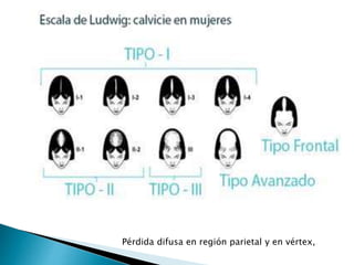 Pérdida difusa en región parietal y en vértex,
 