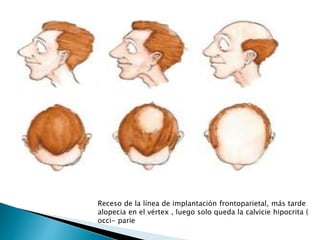 Receso de la línea de implantación frontoparietal, más tarde
alopecia en el vértex , luego solo queda la calvicie hipocrita (
occi- parie
 