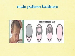 male pattern baldness
 