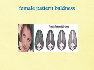 female pattern baldness
 