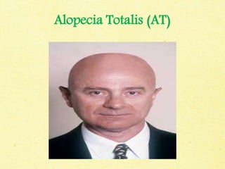 Alopecia Totalis (AT)
 