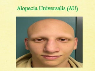 Alopecia Universalis (AU)
 