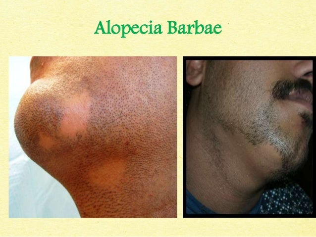 alopecia barbae