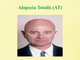 Alopecia Totalis (AT)
 