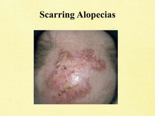 Scarring Alopecias
 