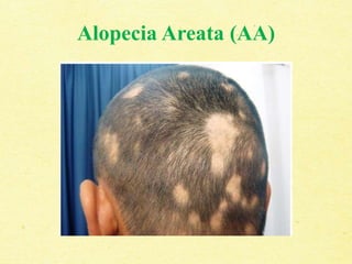 Alopecia Areata (AA)
 