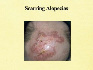 Scarring Alopecias
 