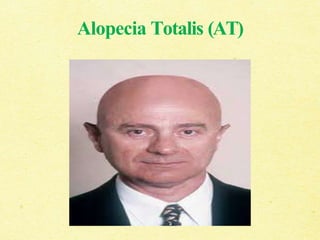 Alopecia Totalis (AT)
 