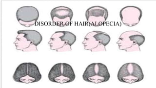 DISORDER OF HAIR(ALOPECIA)
 