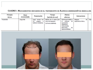 Alopecia androgenica