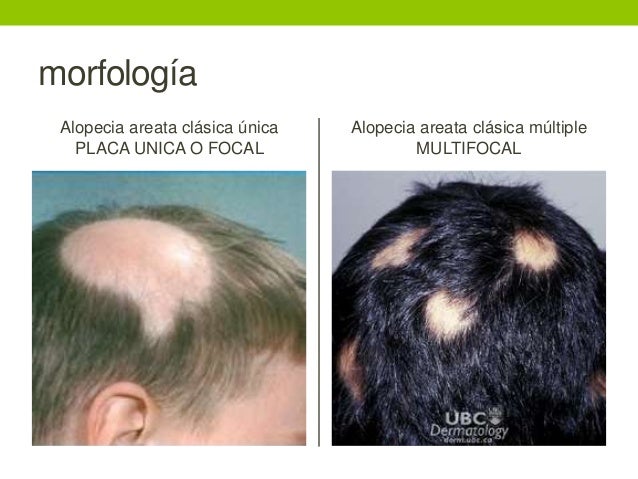 Placa alopecica