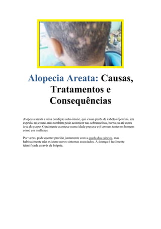 Causas,Alopecia Areata:
Tratamentos e
Consequências
Alopecia areata é uma condição auto-imune, que causa perda de cabelo repentina, em
especial no couro, mas também pode acontecer nas sobrancelhas, barba ou até outra
área do corpo. Geralmente acontece numa idade precoce e é comum tanto em homens
como em mulheres.
Por vezes, pode ocorrer prurido juntamente com a queda dos cabelos, mas
habitualmente não existem outros sintomas associados. A doença é facilmente
identificada através de biópsia.
 