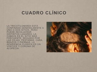 CUADRO CLÍNICO 
LA TRICOTILOMANÍA ESTÁ 
CONFINADA GENERALMENTE A 
UNO O DOS SITIOS, PERO 
PUEDE INVOLUCRAR 
DISTINTOS LUGARES. LA 
CABEZA ES EL SITIO MÁS 
FRECUENTE, SEGUIDO POR 
LAS CEJAS, PESTAÑAS, CARA, 
BRAZOS Y PIERNAS. LA 
APARIENCIA CLÁSICA ES UN 
VÓRTICE Y CORONA DE 
ALOPECIA. 
 