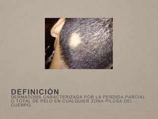 DEFINICIÓN 
DERMATOSIS CARACTERIZADA POR LA PERDIDA PARCIAL 
O TOTAL DE PELO EN CUALQUIER ZONA PILOSA DEL 
CUERPO. 
 