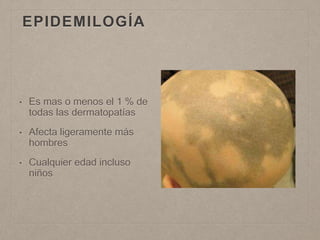 EPIDEMILOGÍA 
• Es mas o menos el 1 % de 
todas las dermatopatías 
• Afecta ligeramente más 
hombres 
• Cualquier edad incluso 
niños 
 