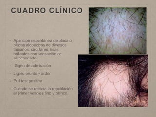 CUADRO CLÍNICO 
• Aparición espontánea de placa o 
placas alopécicas de diversos 
tamaños, circulares, lisas, 
brillantes con sensación de 
alcochonado. 
• Signo de admiración 
• Ligero prurito y ardor 
• Pull test positivo 
• Cuando se reinicia la repoblación 
el primer vello es fino y blanco, 
 
