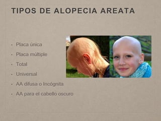 TIPOS DE ALOPECIA AREATA 
• Placa única 
• Placa múltiple 
• Total 
• Universal 
• AA difusa o Incógnita 
• AA para el cabello oscuro 
 